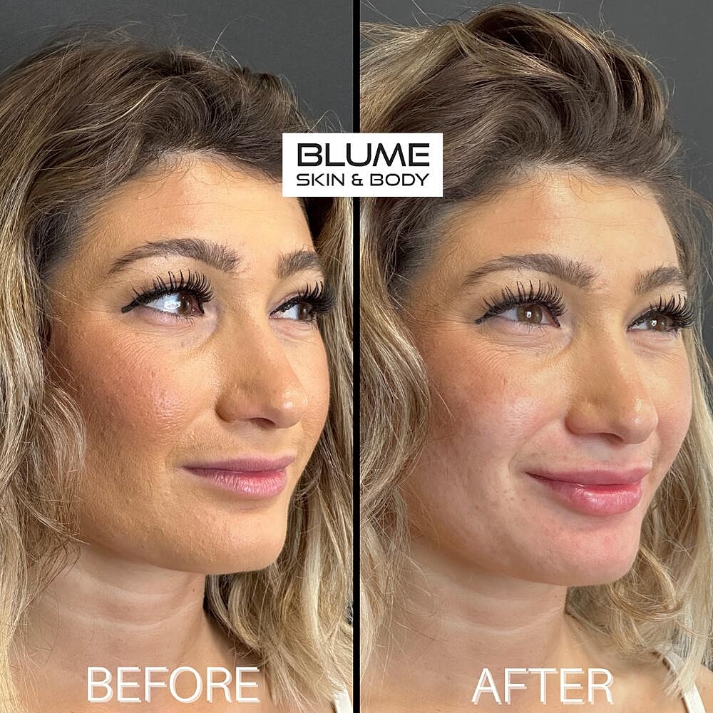 Dermal Fillers Before & After