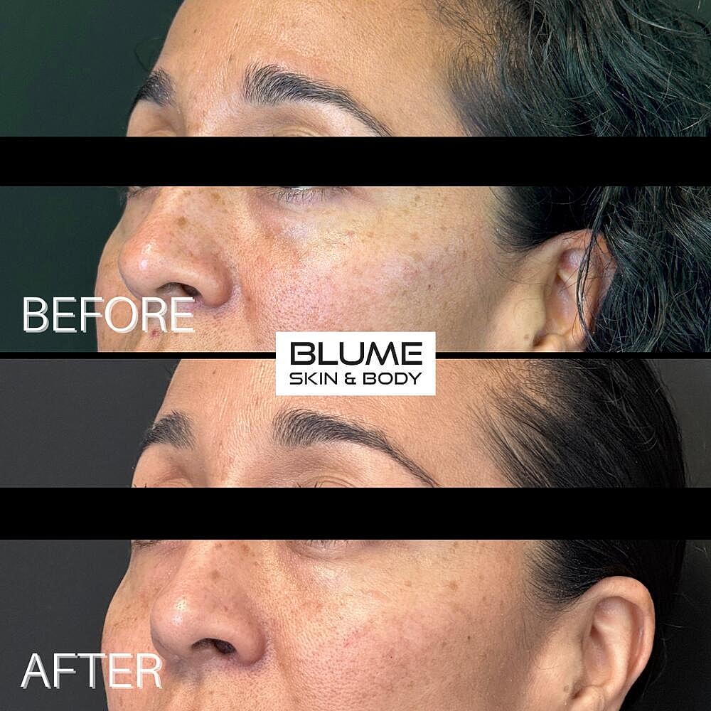 Dermal Fillers Before & After