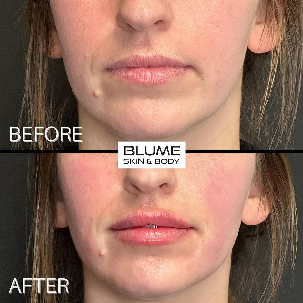 Dermal Fillers Before & After