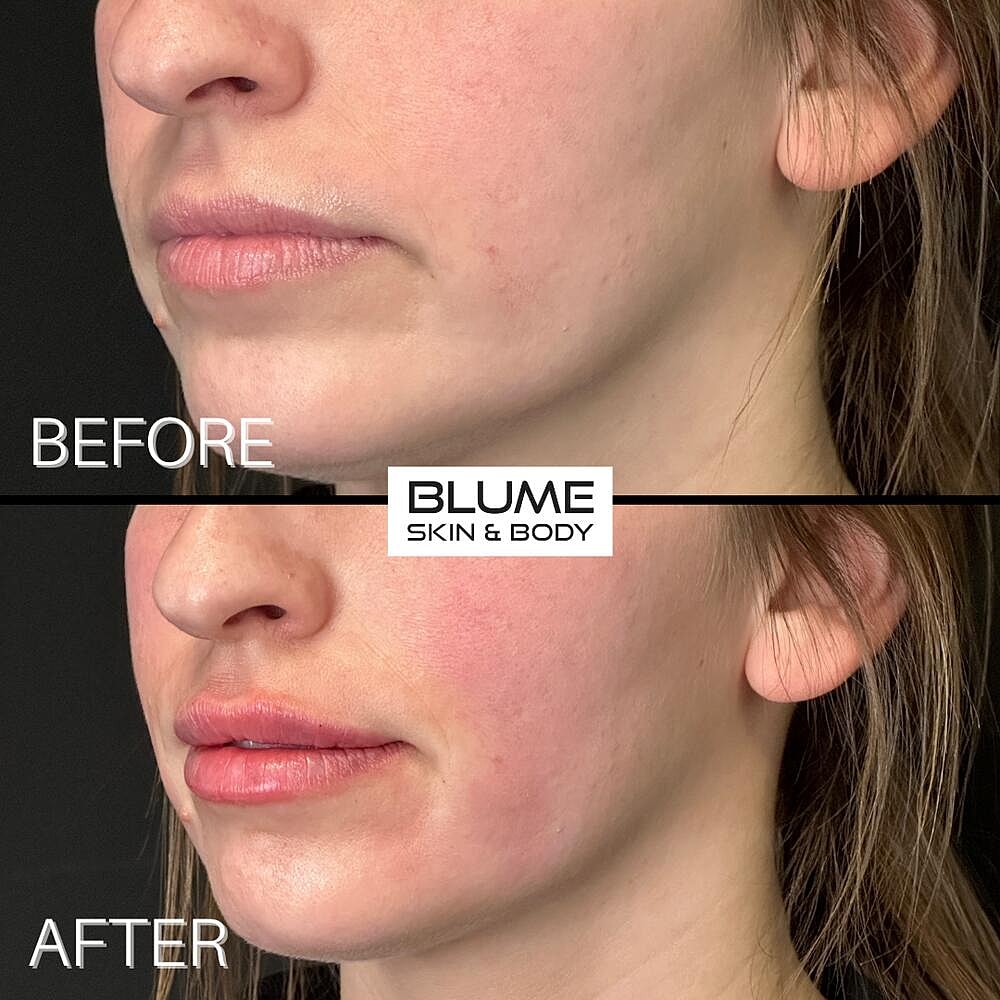 Dermal Fillers Before & After