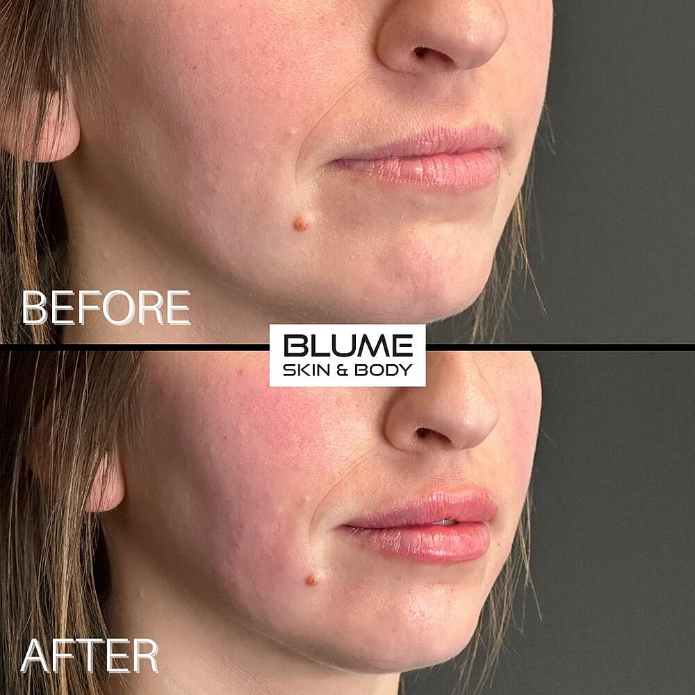 Dermal Fillers Before & After