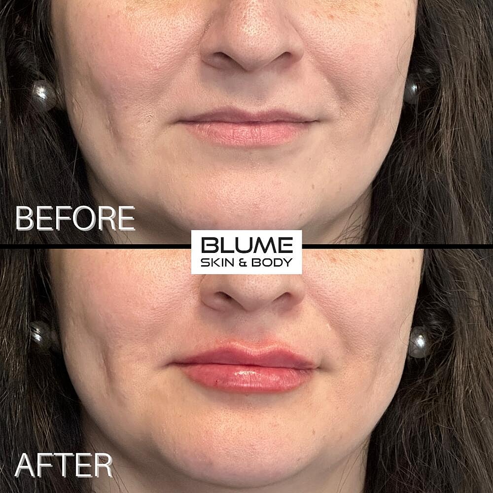Dermal Fillers Before & After