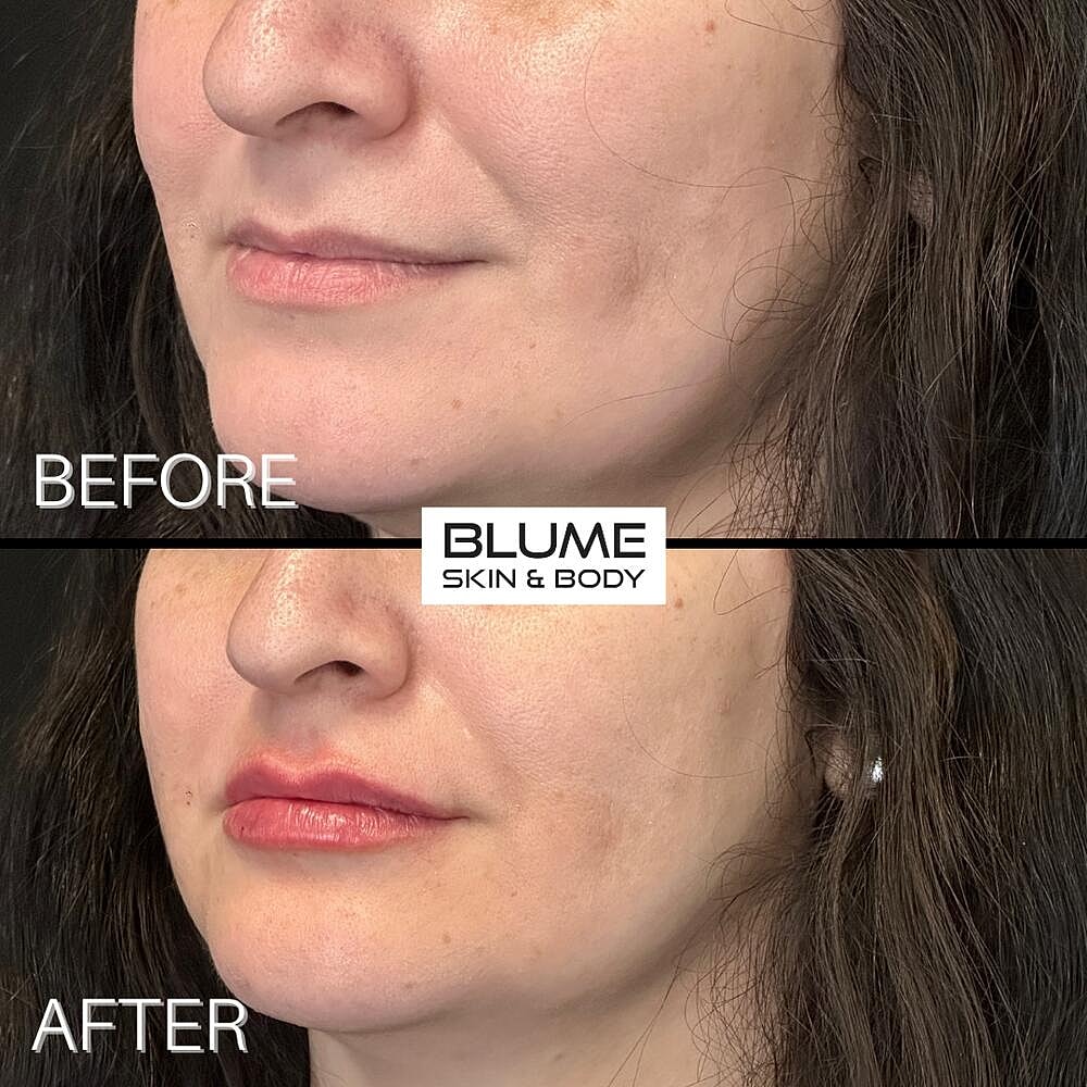 Dermal Fillers Before & After