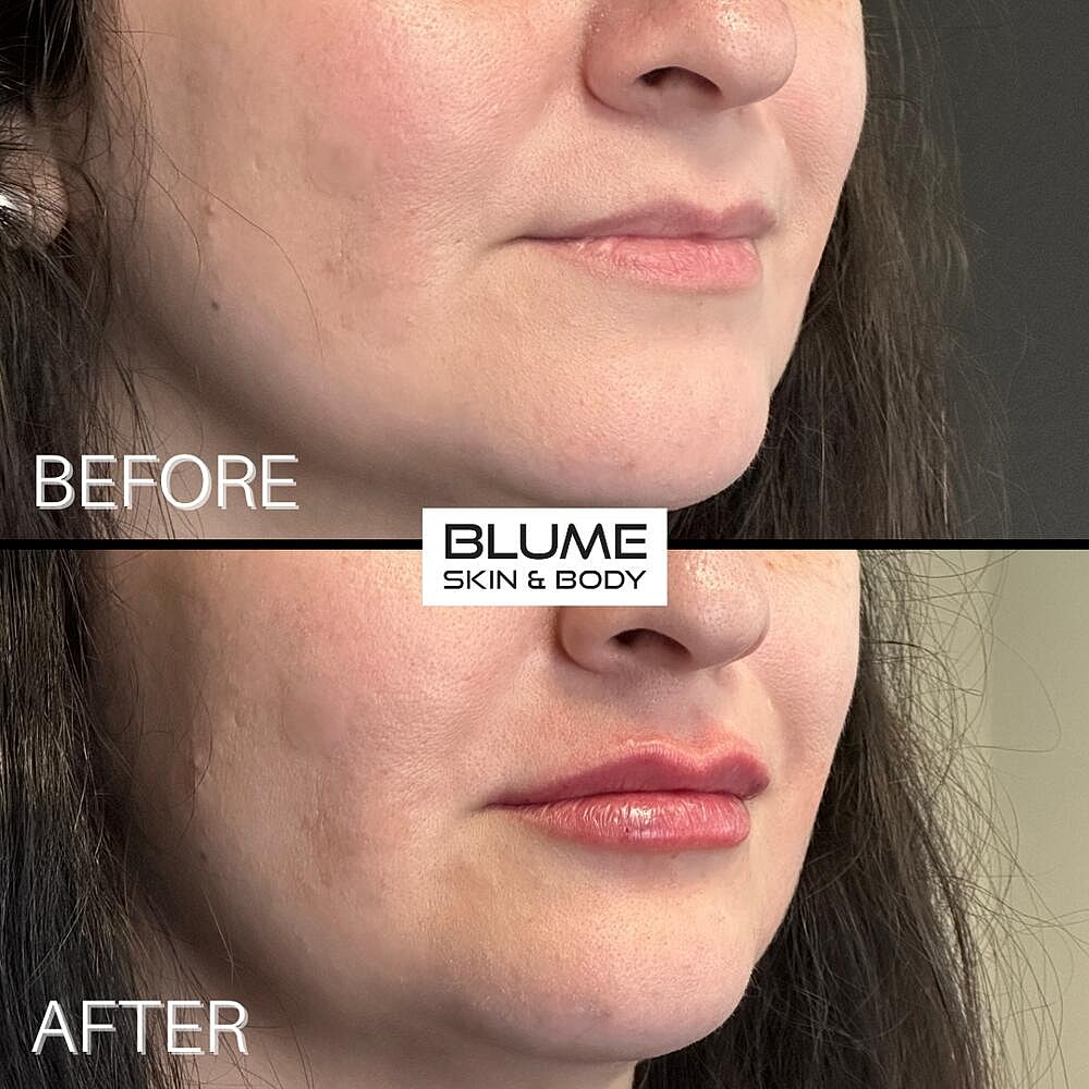 Dermal Fillers Before & After