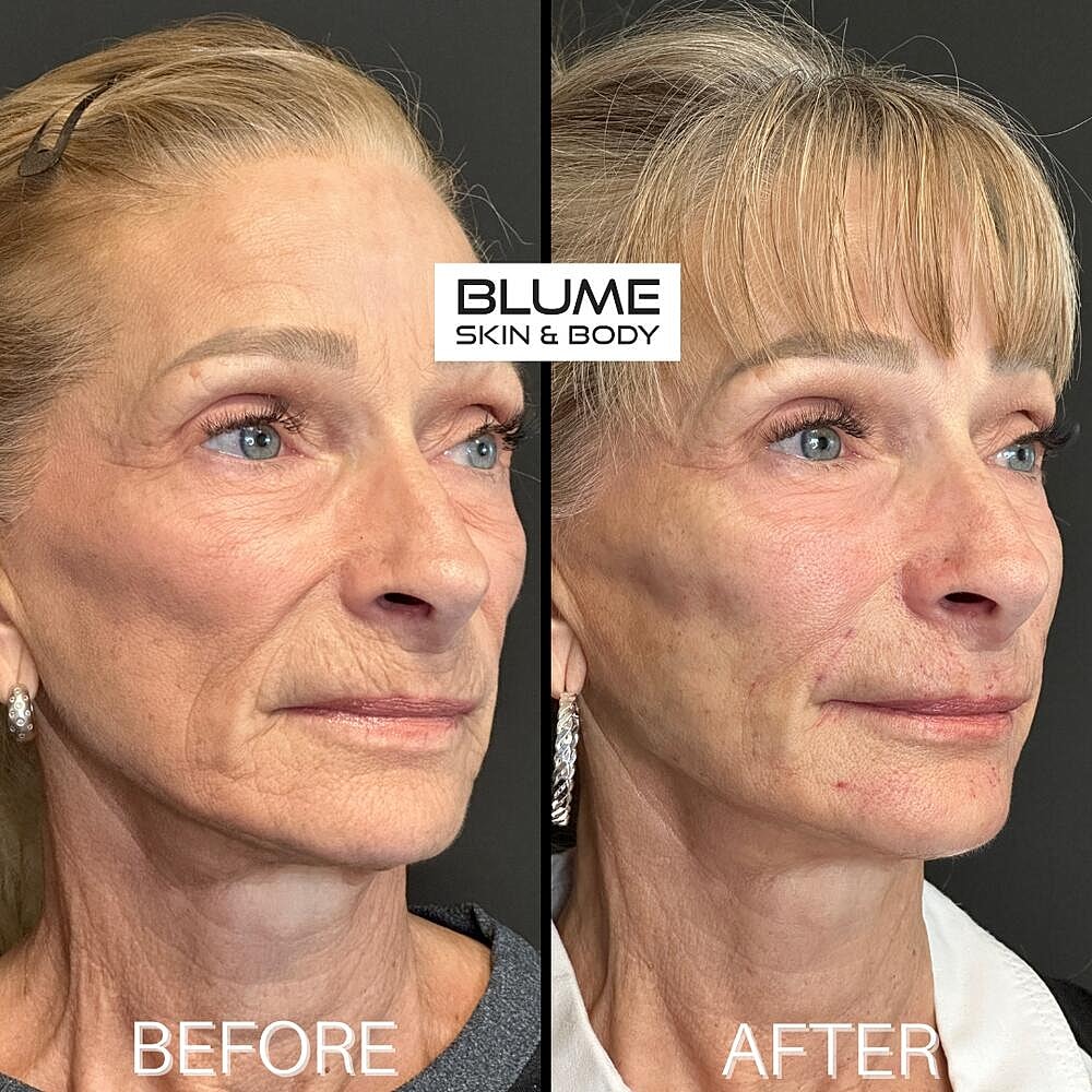 Dermal Fillers Before & After