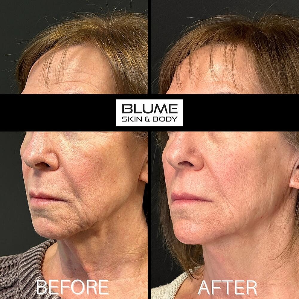 Dermal Fillers Before & After