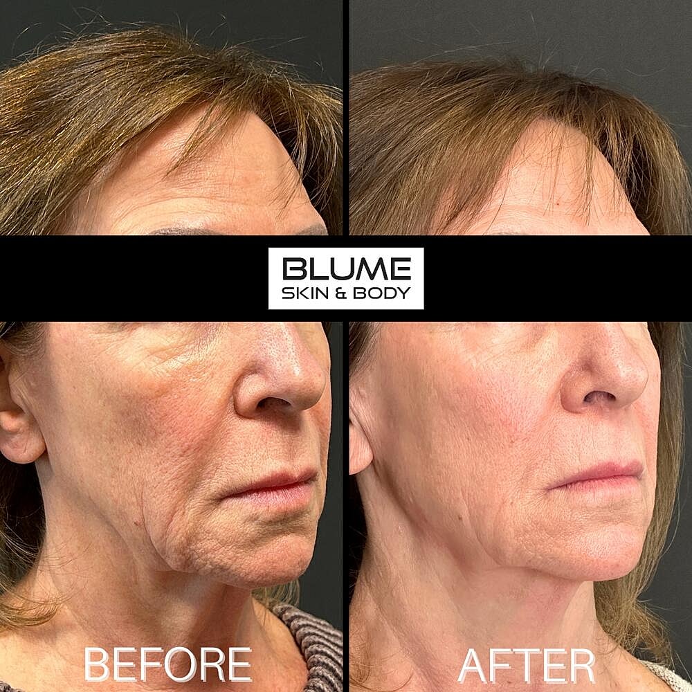 Dermal Fillers Before & After