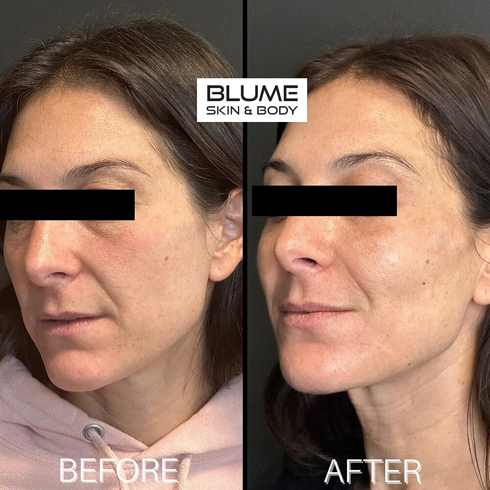 Dermal Fillers Before & After