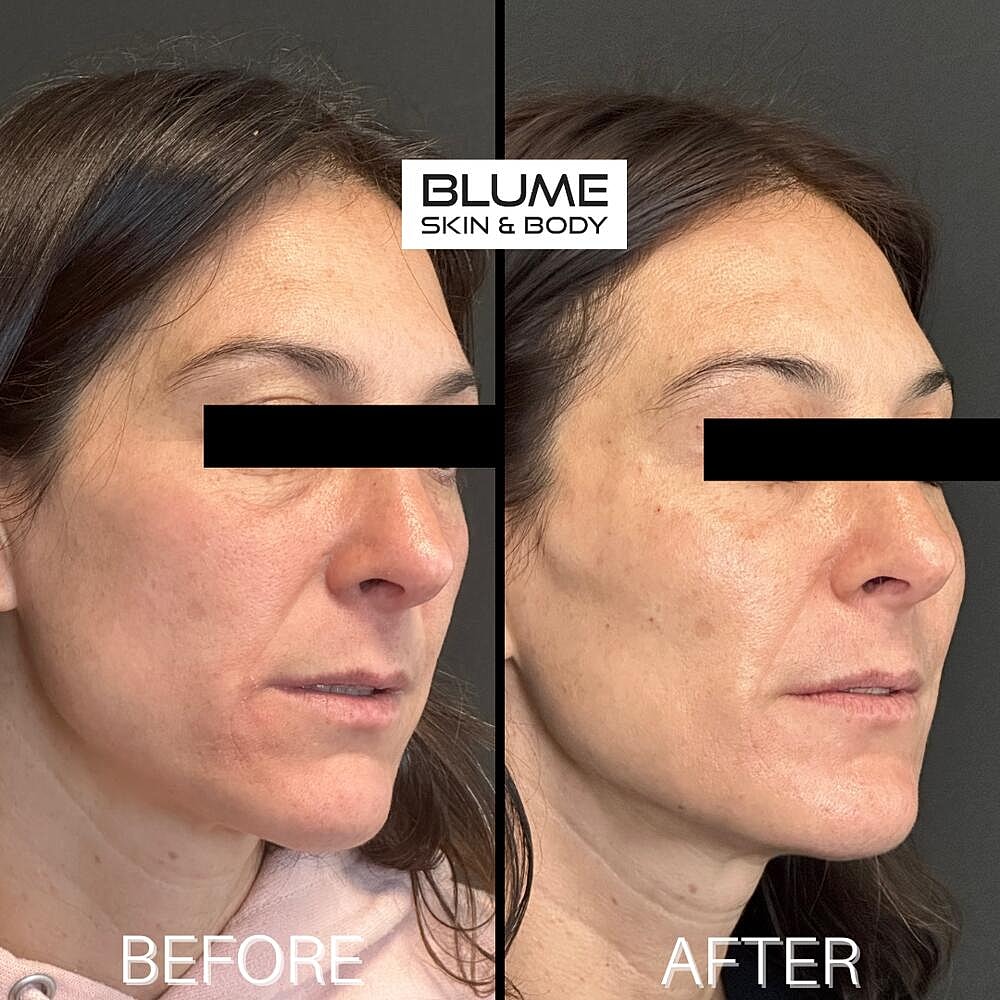 Dermal Fillers Before & After