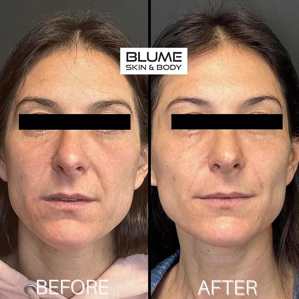 Dermal Fillers Before & After