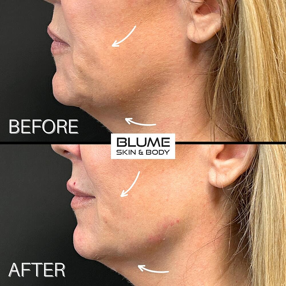 Dermal Fillers Before & After