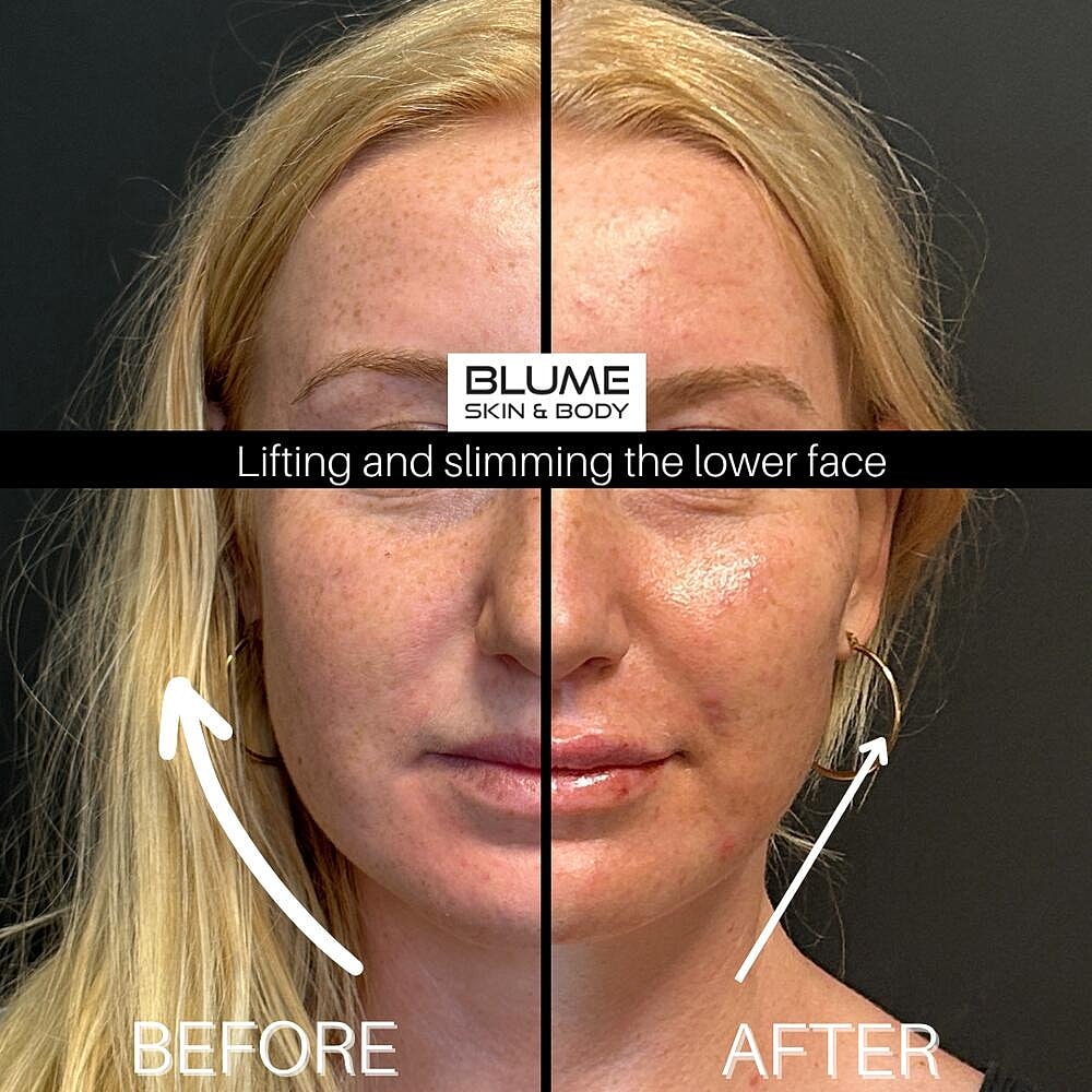 Dermal Fillers Before & After