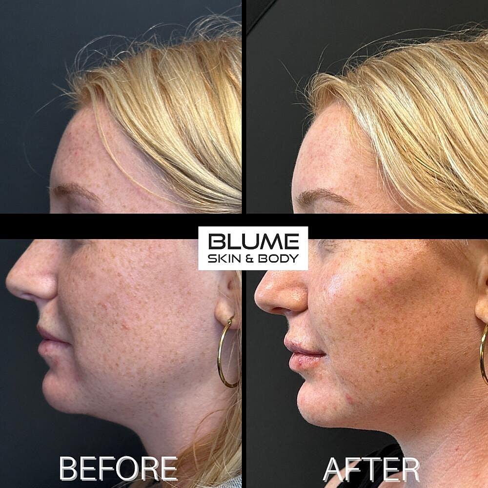 Dermal Fillers Before & After