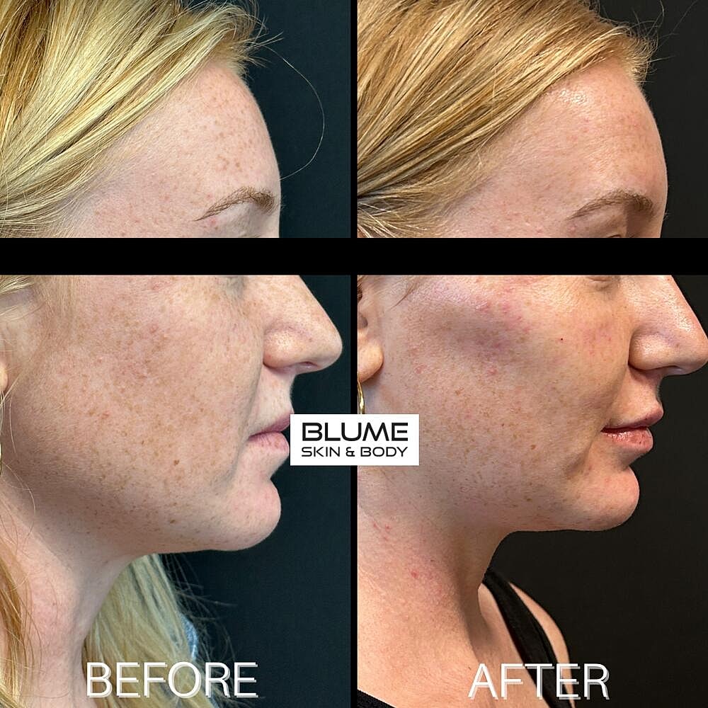 Dermal Fillers Before & After