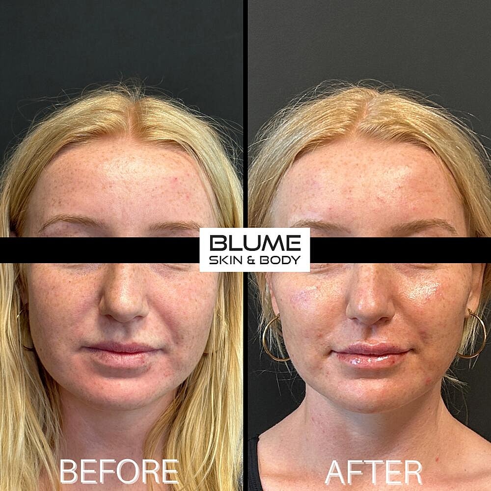 Dermal Fillers Before & After