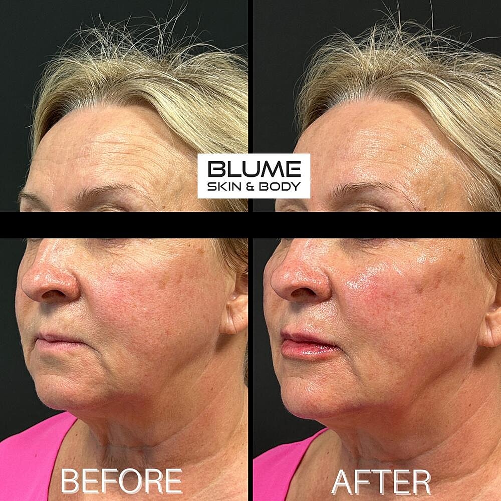 Dermal Fillers Before & After