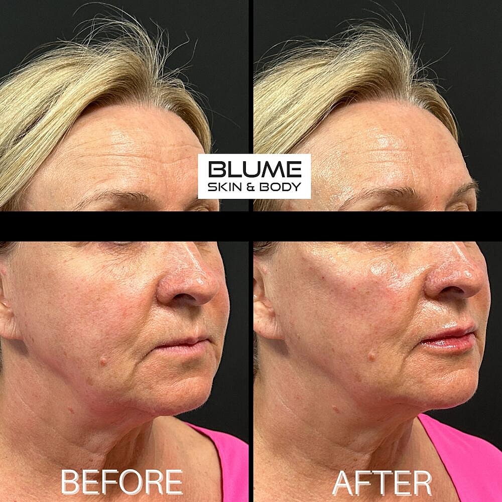 Dermal Fillers Before & After