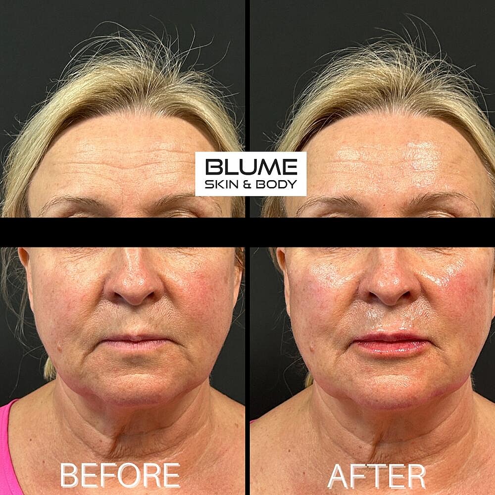 Dermal Fillers Before & After