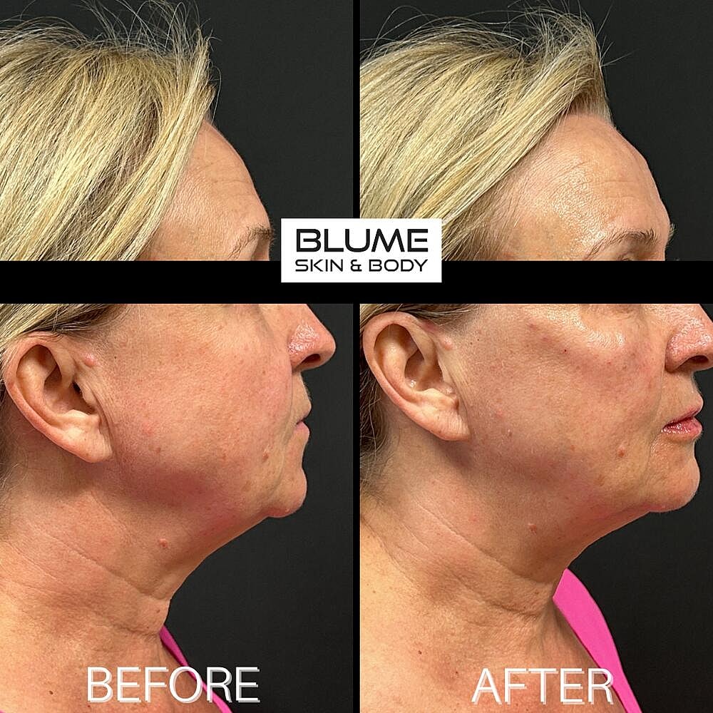 Dermal Fillers Before & After