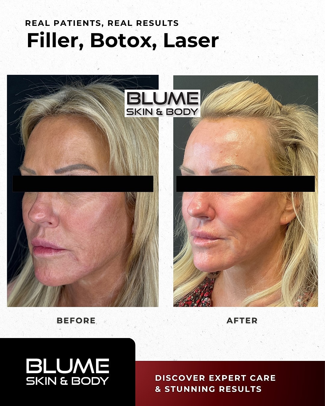 Before and after aesthetic treatment results.