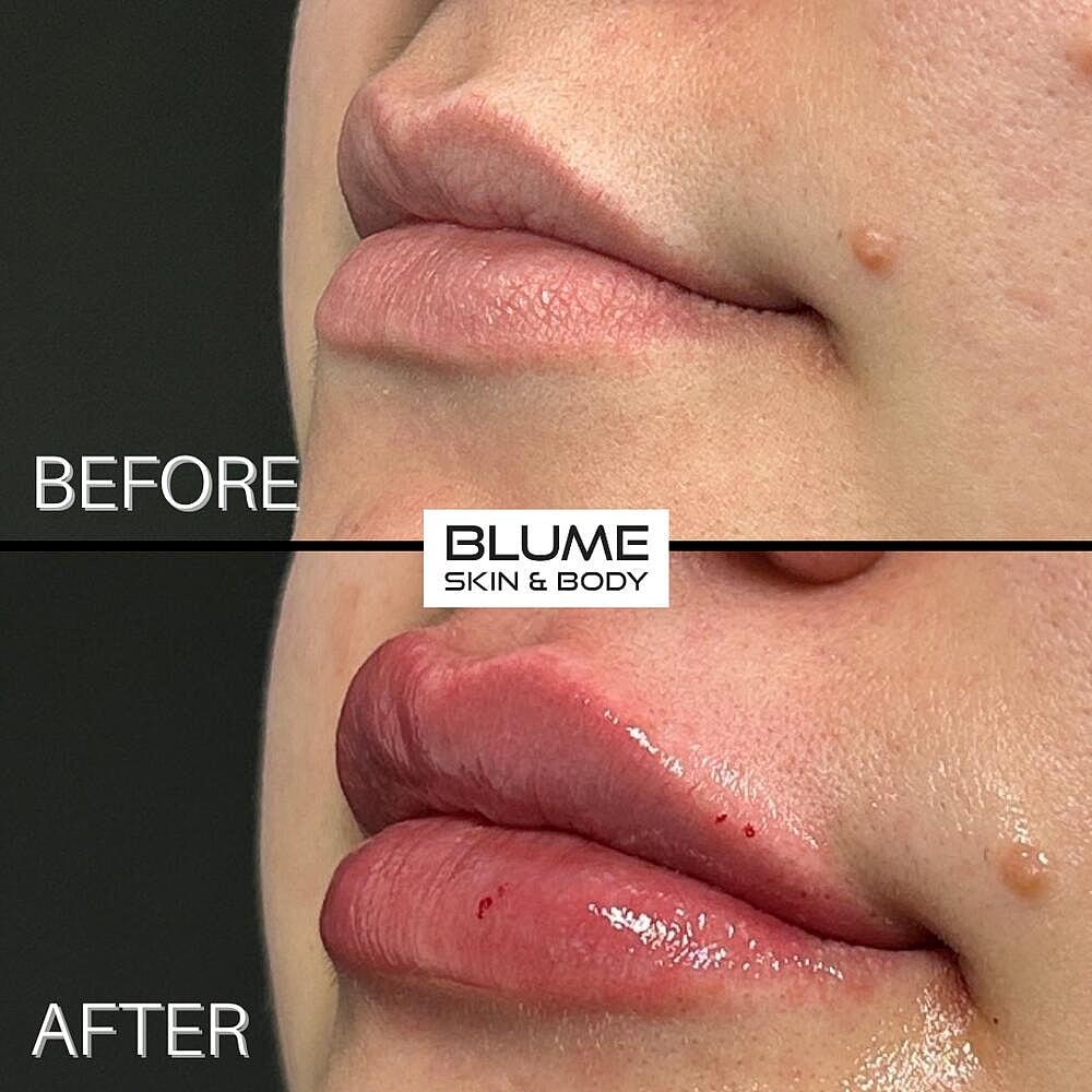 Dermal Fillers Before & After