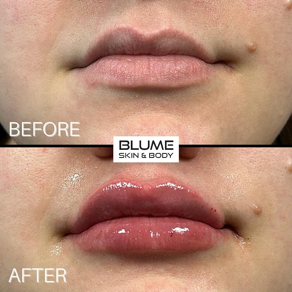 Dermal Fillers Before & After