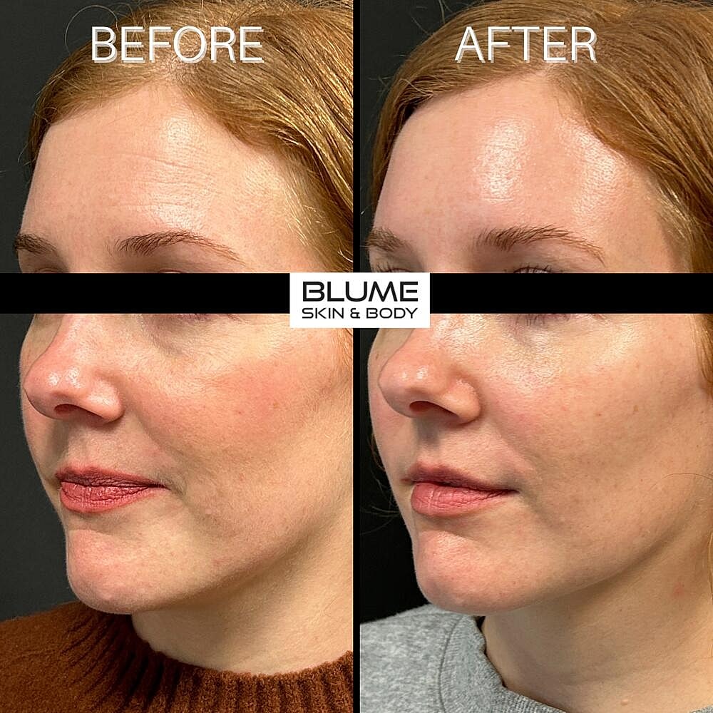 Dermal Fillers Before & After