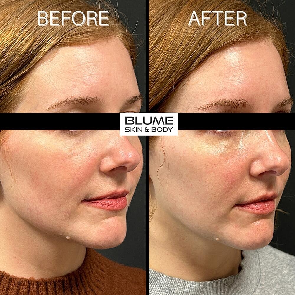 Dermal Fillers Before & After