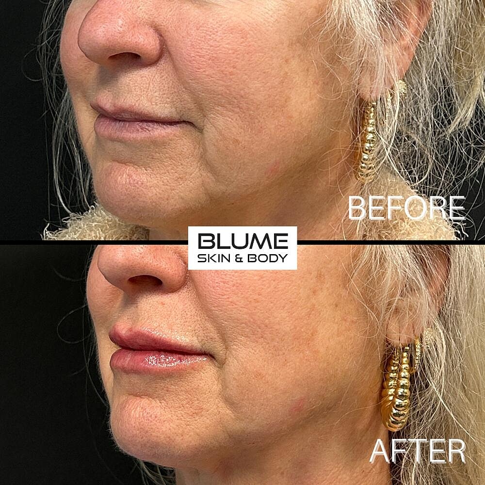 Dermal Fillers Before & After