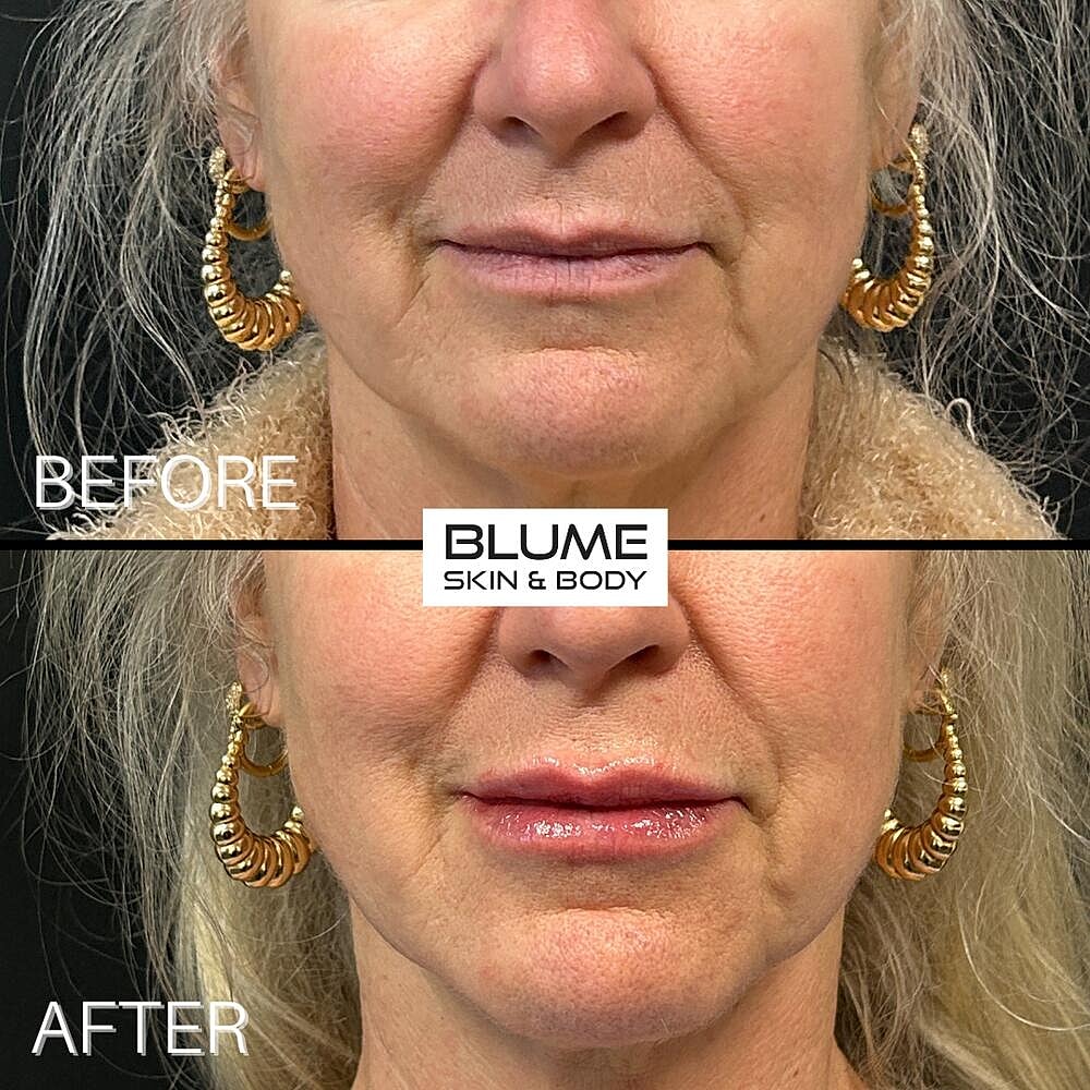 Dermal Fillers Before & After