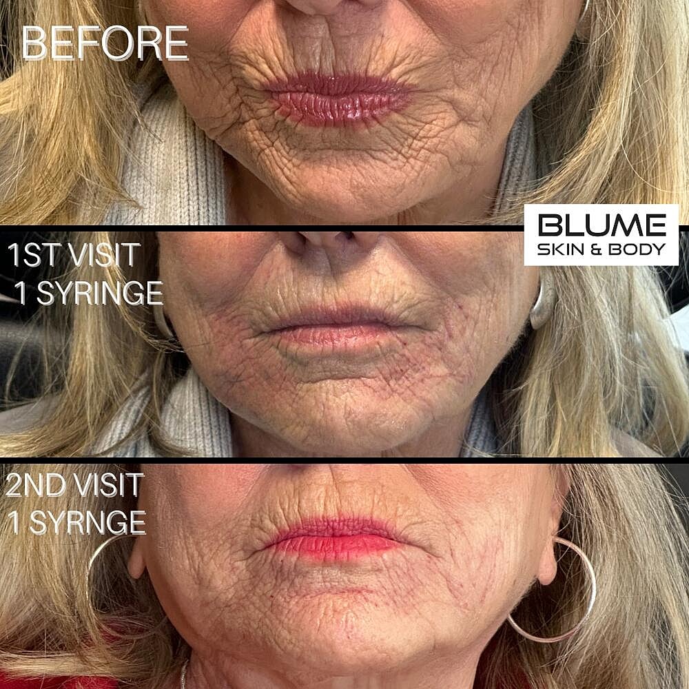 Dermal Fillers Before & After