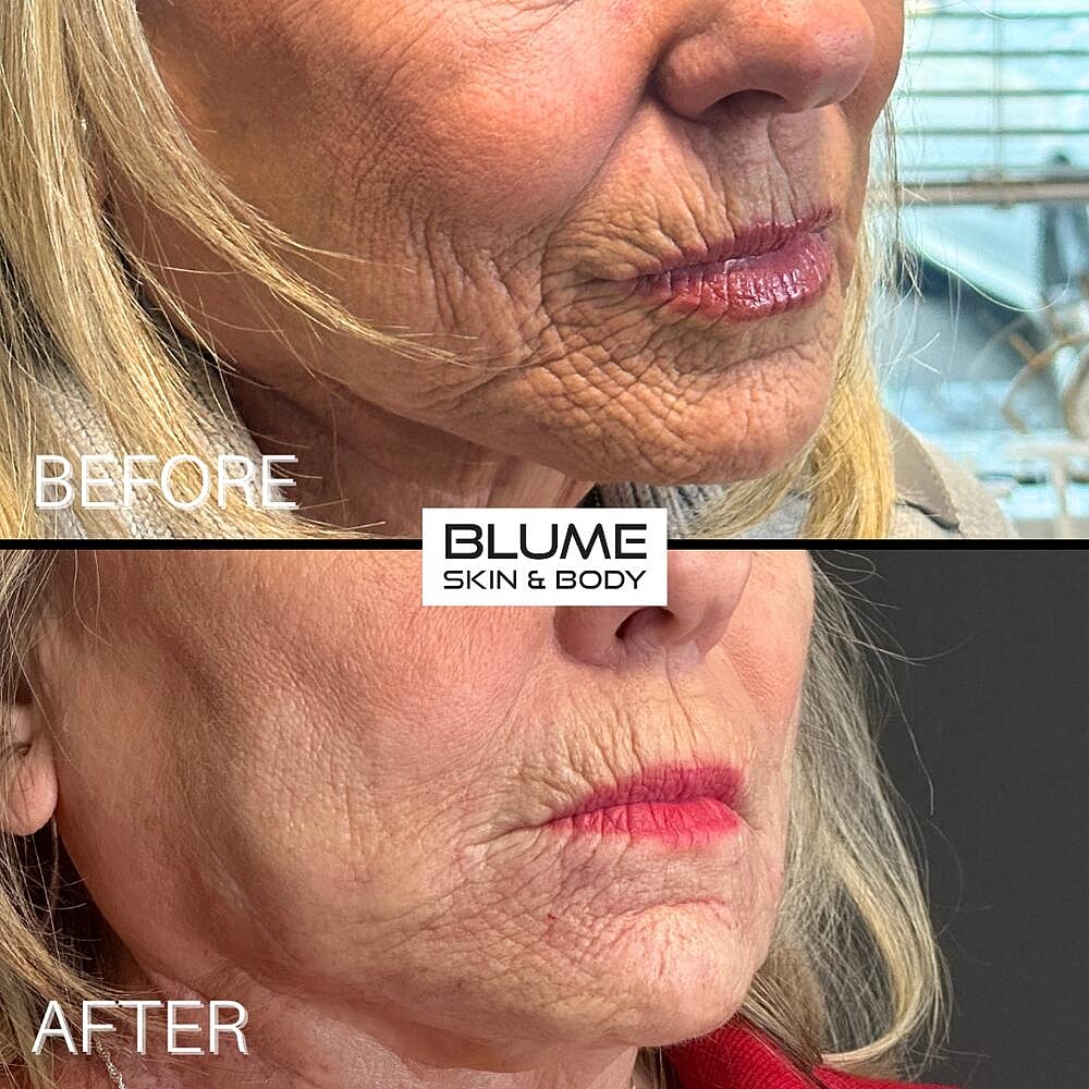 Dermal Fillers Before & After