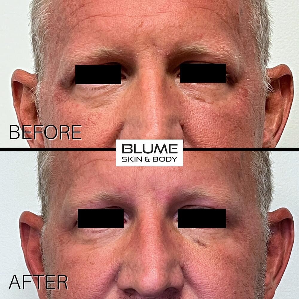 Dermal Fillers Before & After