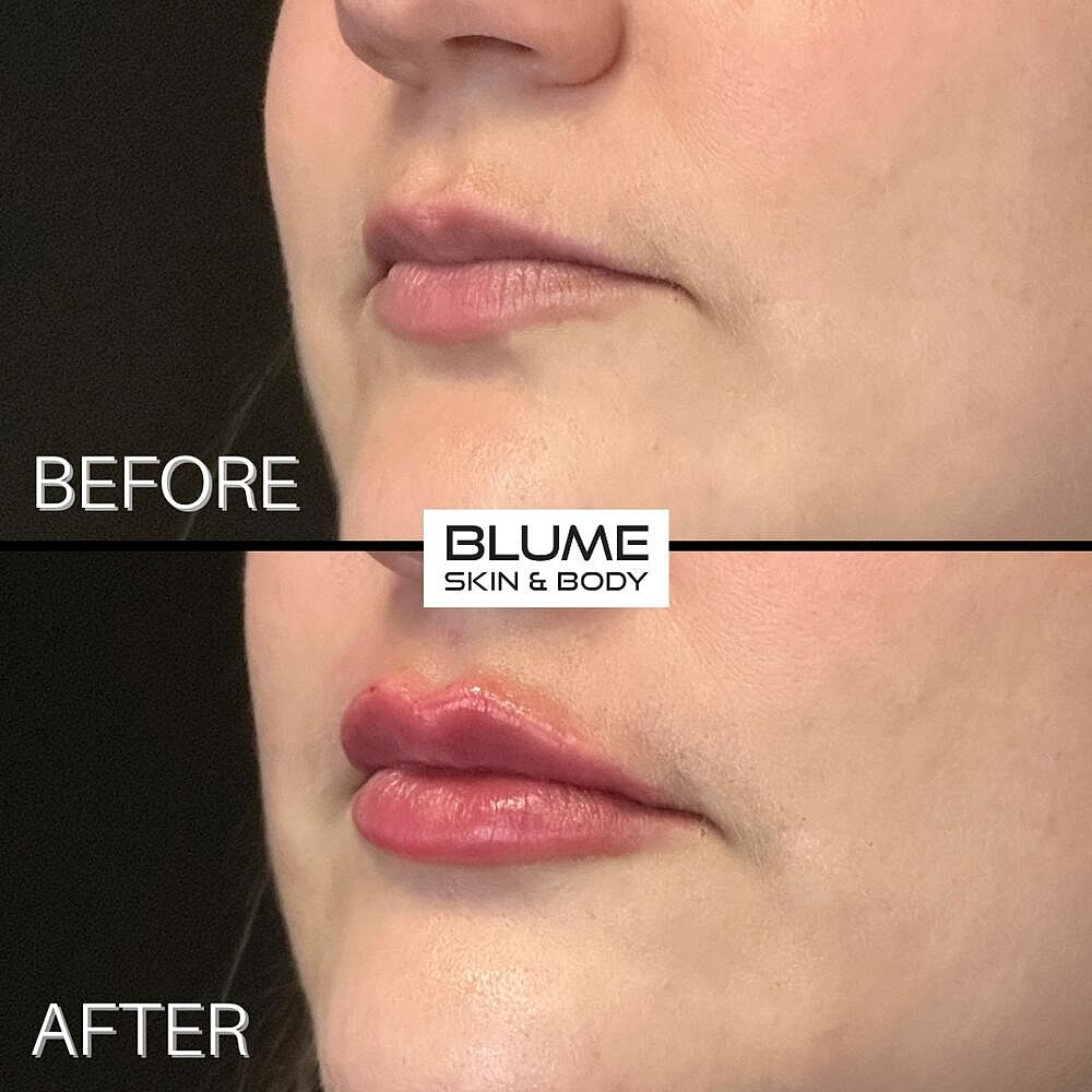 Dermal Fillers Before & After