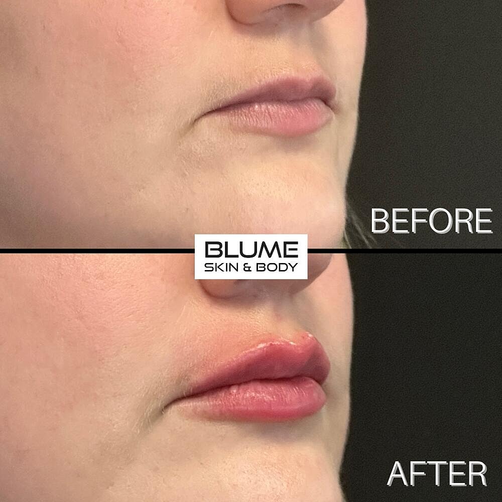Dermal Fillers Before & After