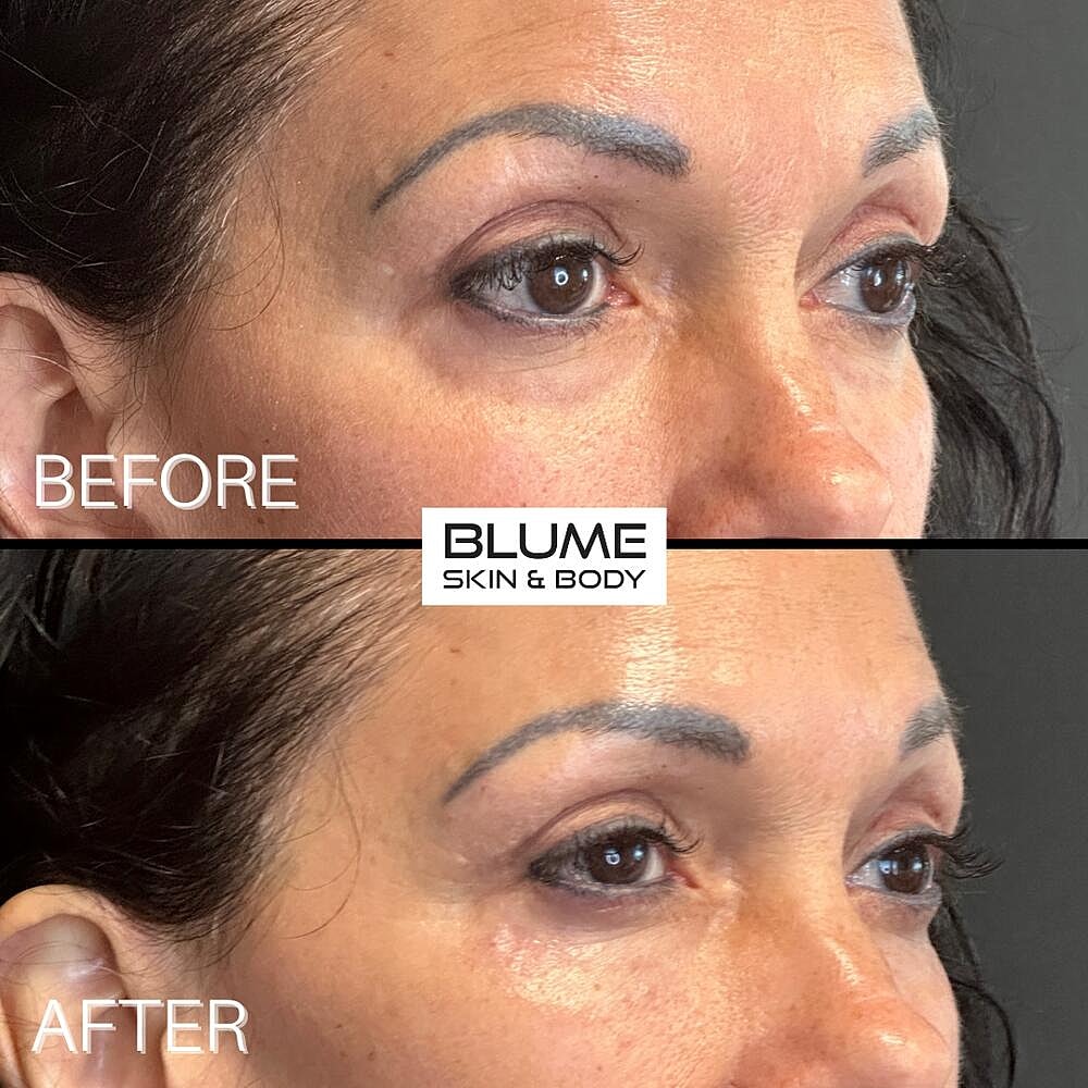 Dermal Fillers Before & After
