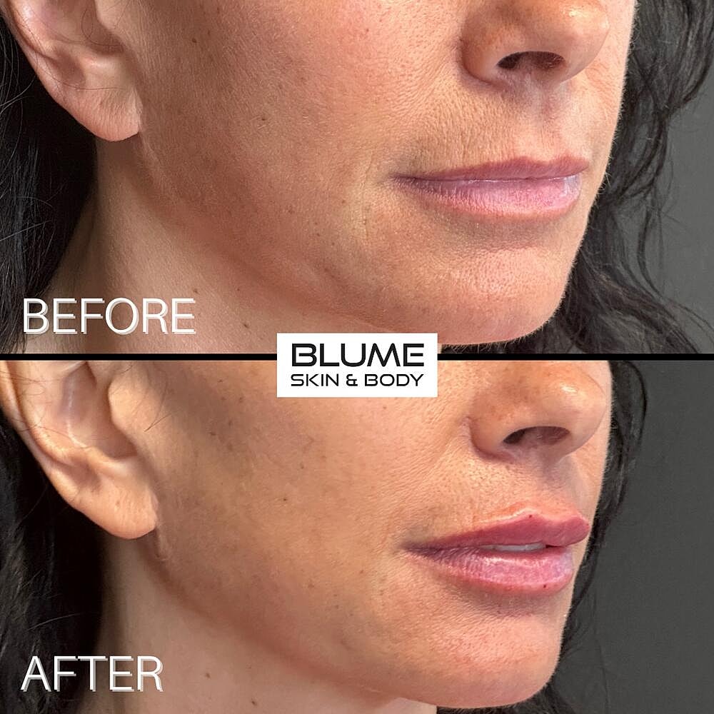 Dermal Fillers Before & After