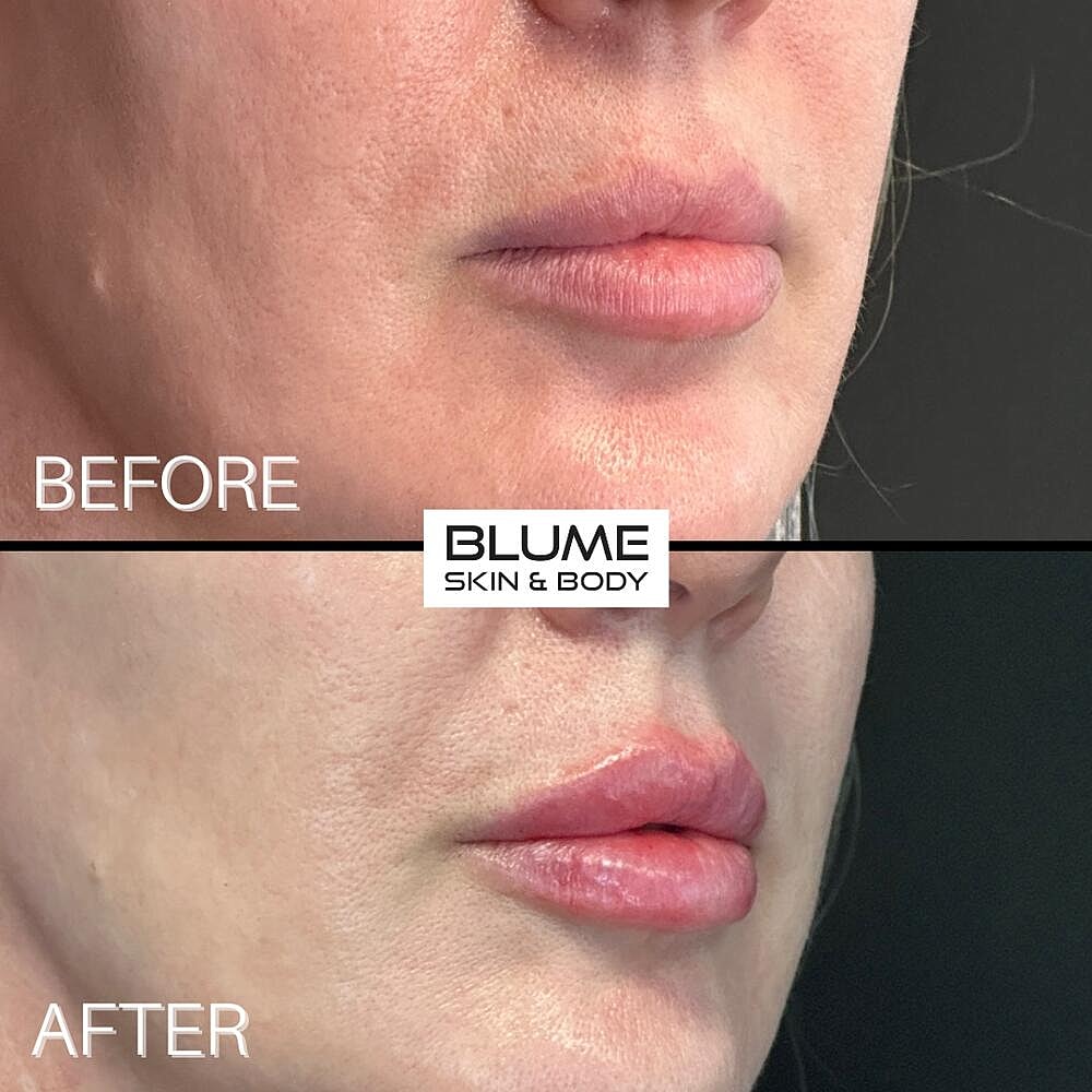 Dermal Fillers Before & After