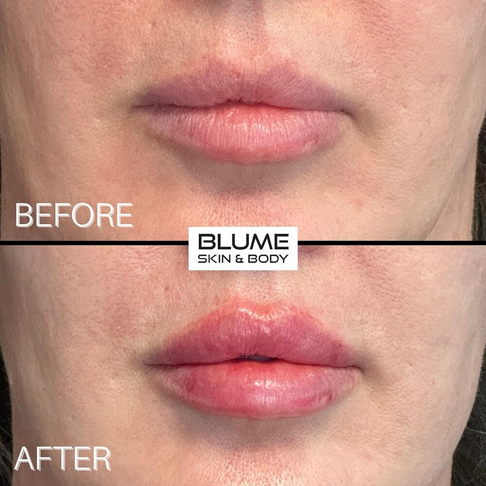 Dermal Fillers Before & After