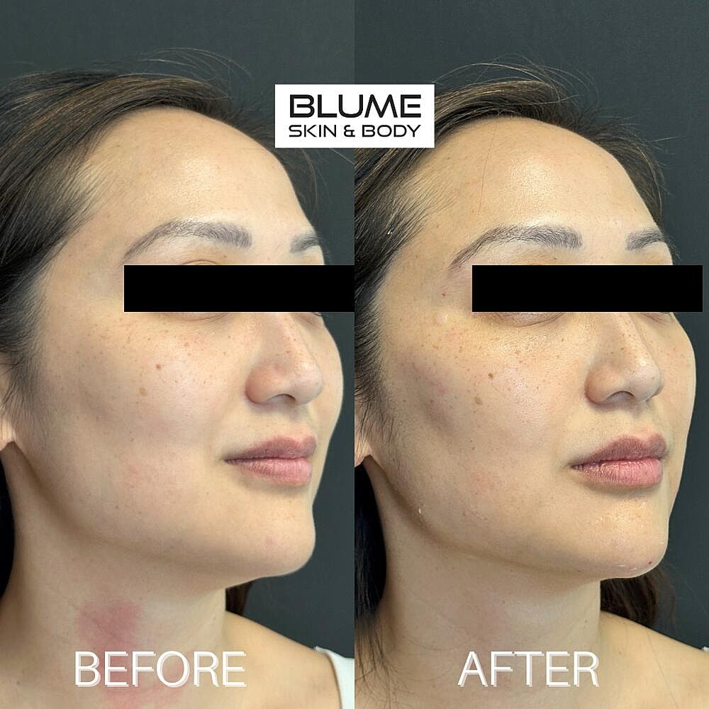 Dermal Fillers Before & After
