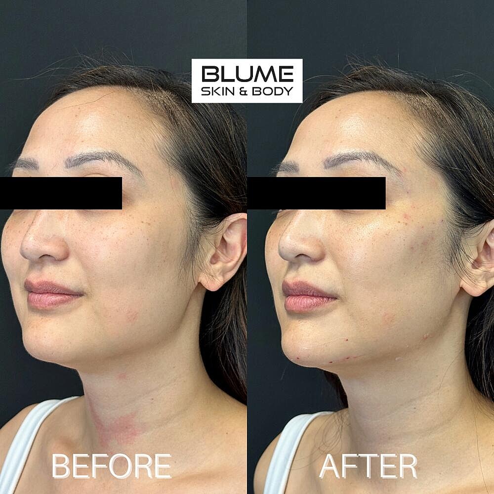Dermal Fillers Before & After