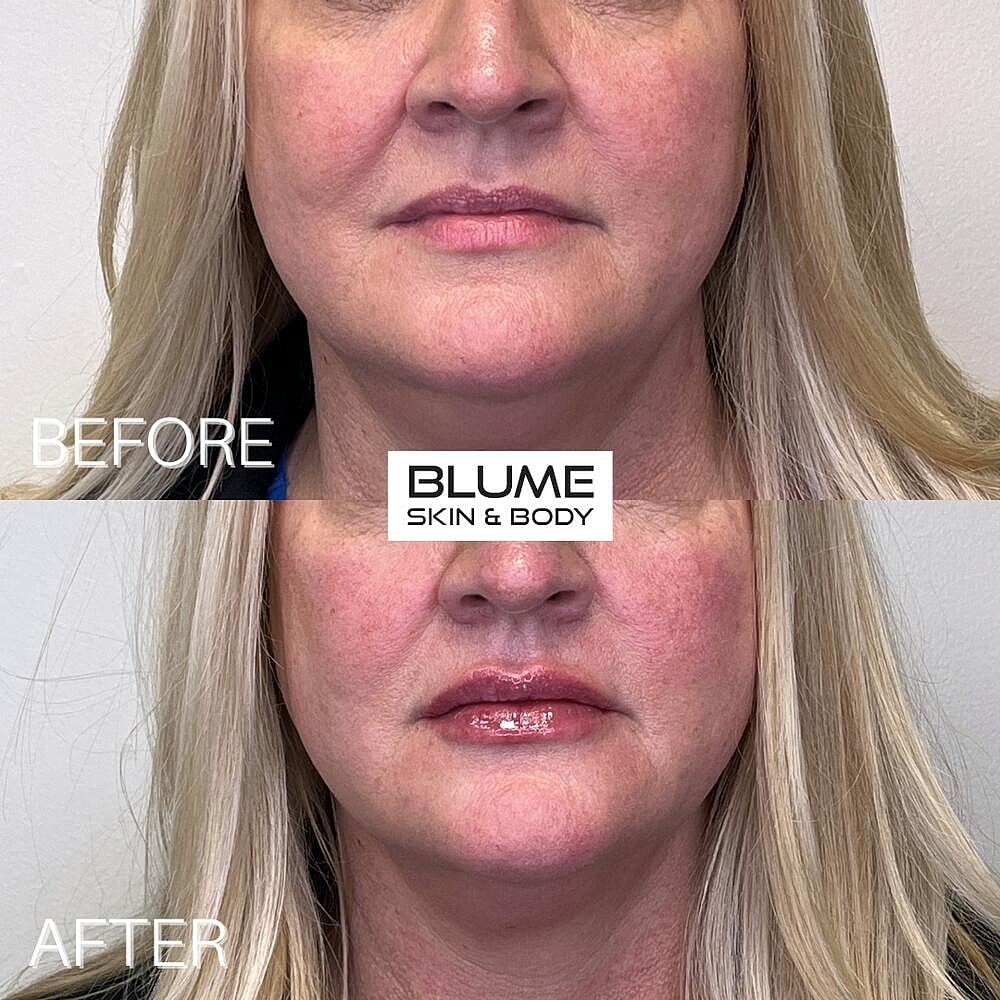 Dermal Fillers Before & After