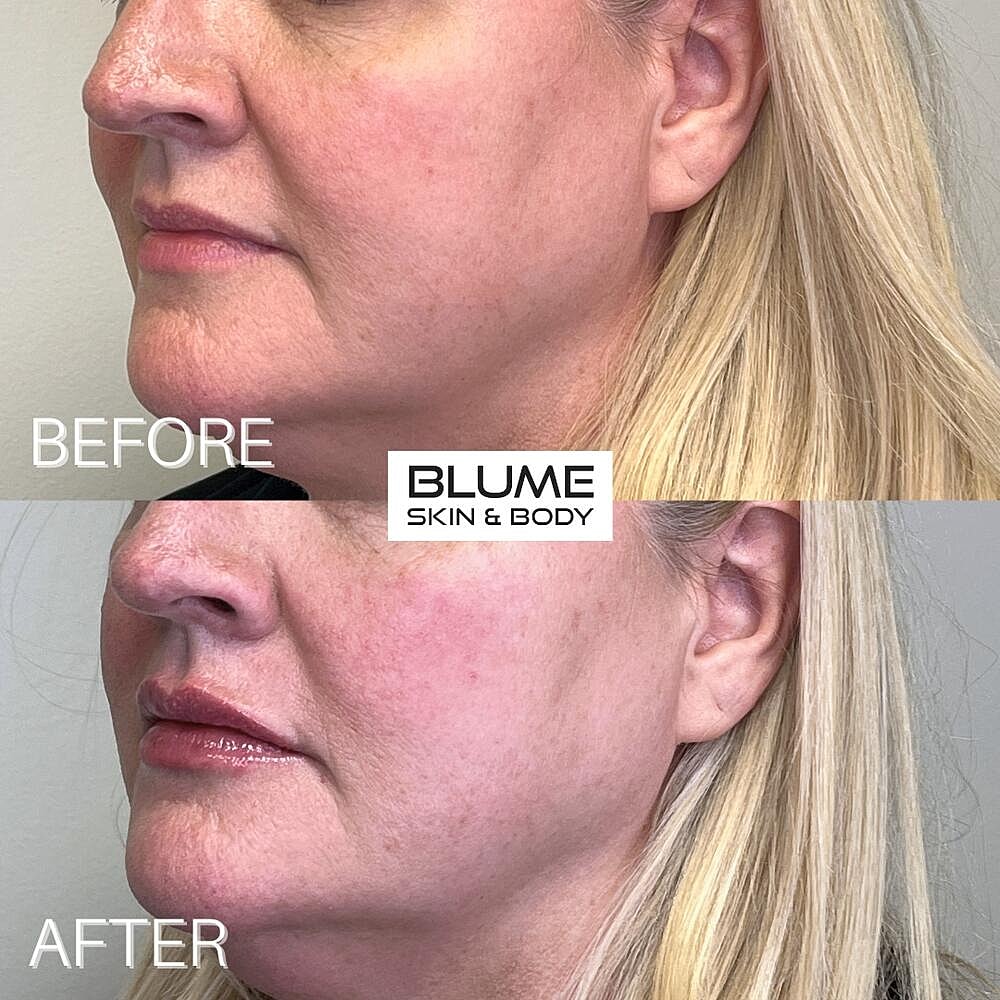 Dermal Fillers Before & After