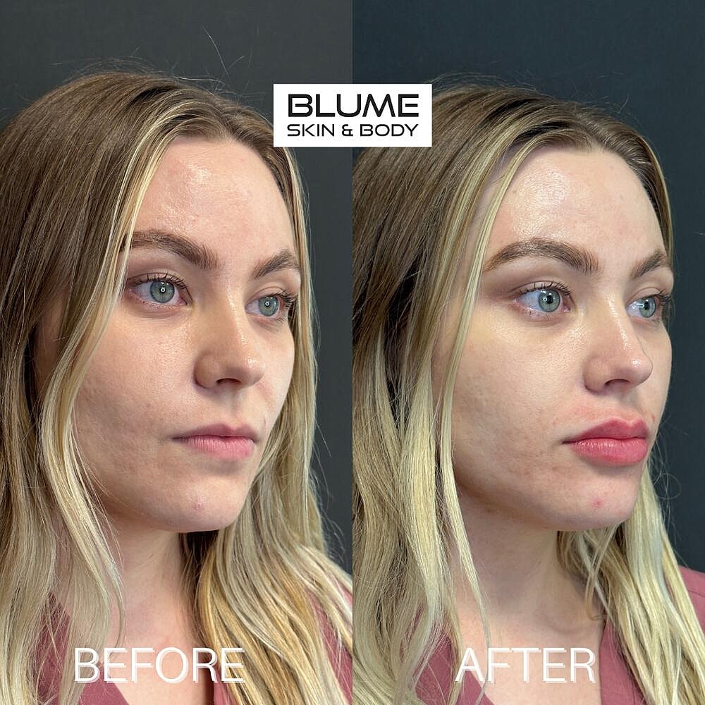 Dermal Fillers Before & After