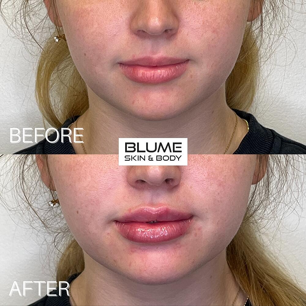 Dermal Fillers Before & After