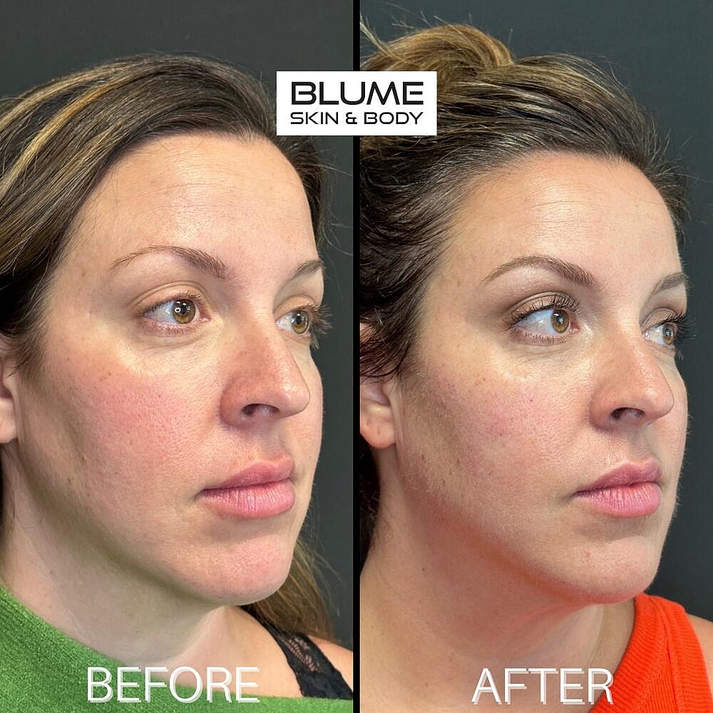 Dermal Fillers Before & After
