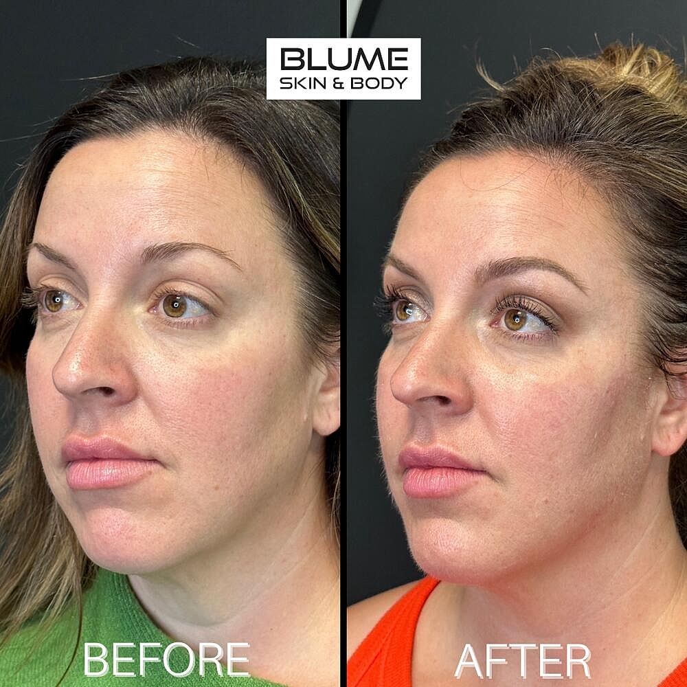 Dermal Fillers Before & After