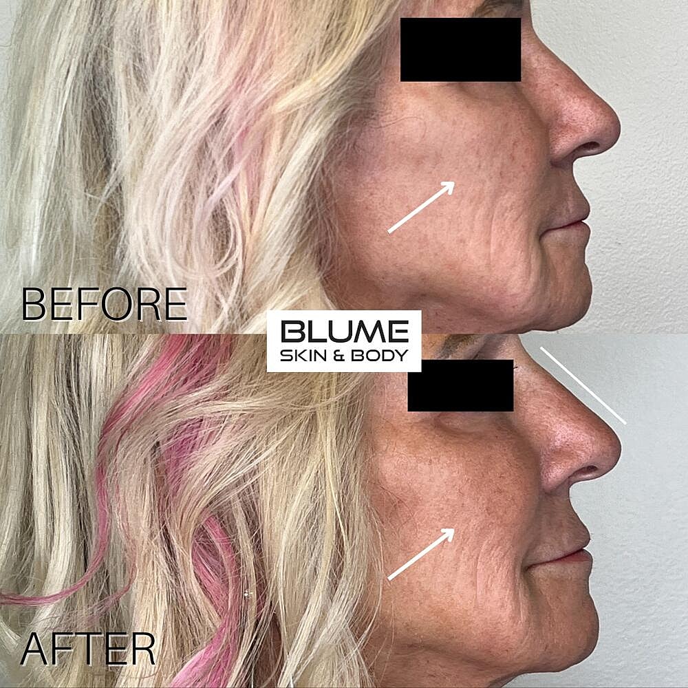 Dermal Fillers Before & After