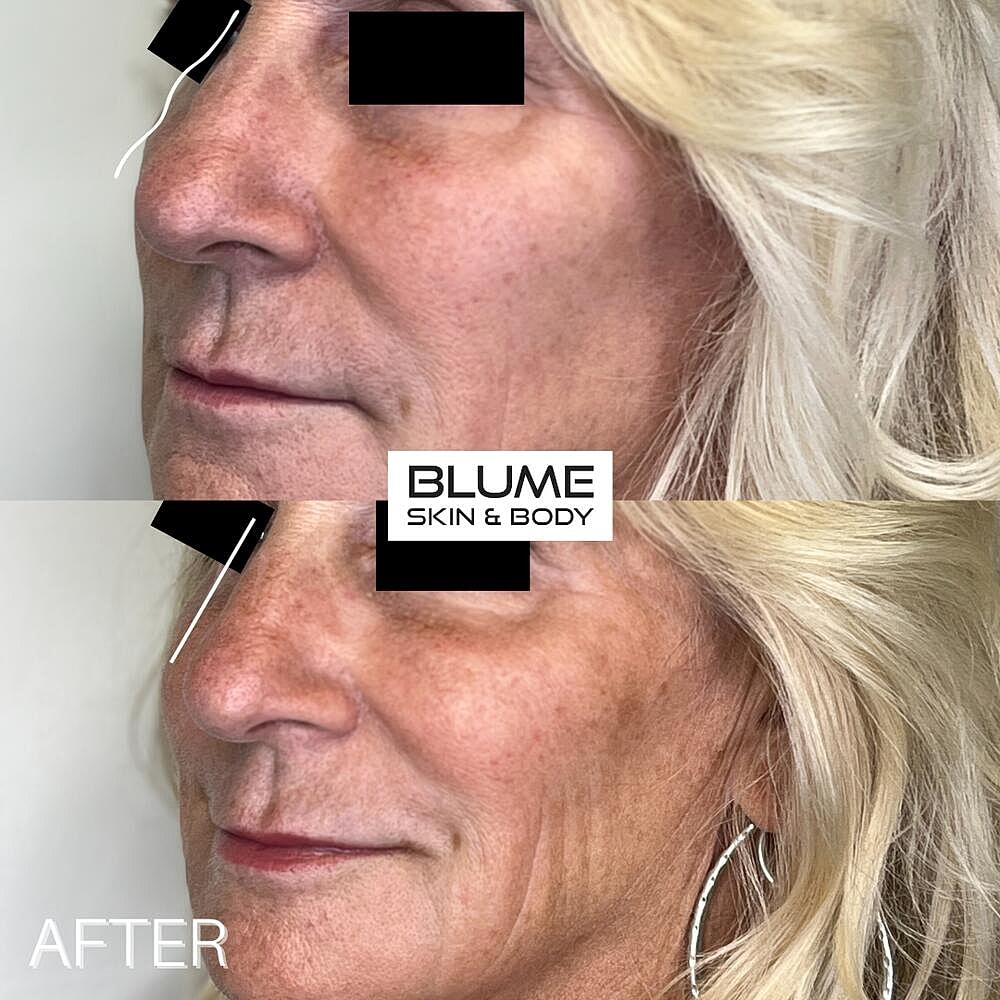 Dermal Fillers Before & After