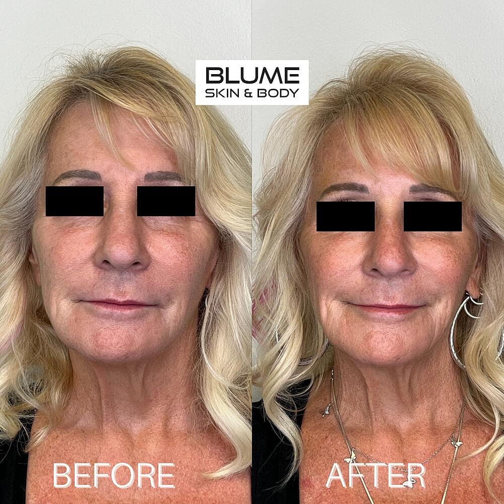Dermal Fillers Before & After